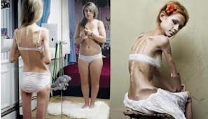 Anorexia y Bulimia. La mujer más anoréxica del mundo.
